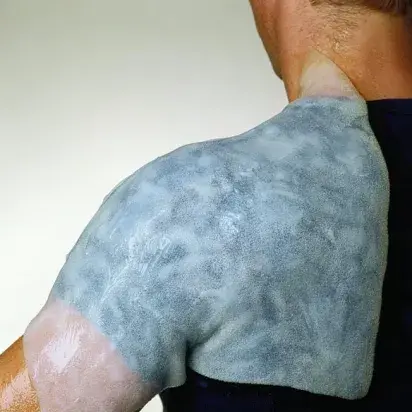 BurnFree: Apósitos anti quemaduras