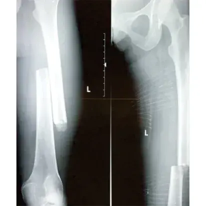 Férula de tracción CT-6