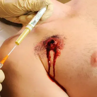 Aguja de Descompresión Torácica: TPAK