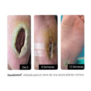 Sistema DynaStretch utilizado para el cierre de una ulcera