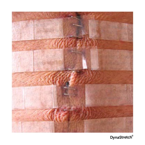 Tiras de cierre DynaStretch para tratamiento de heridas